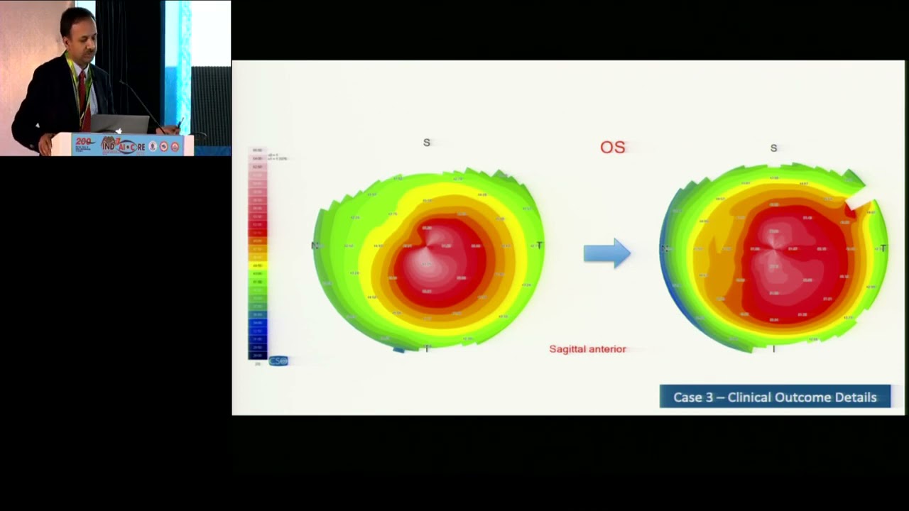 Femtosecond laser (Ziemer Z6) assisted Cross-linked lenticule implantation for keratoconus
