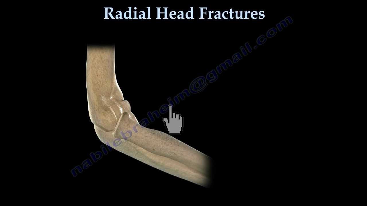 Radial Head Fracture- Everything You Need To Know- Dr. Nabil Ebraheim