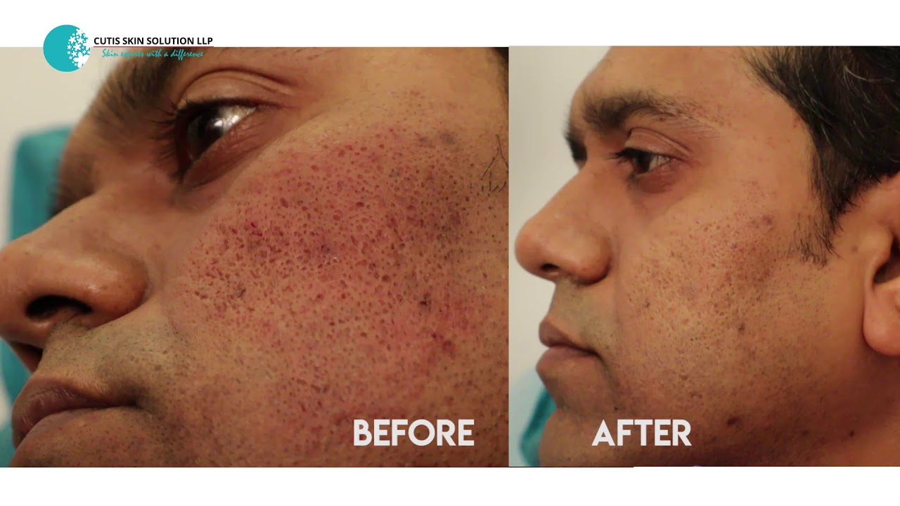 Acne scars treatments