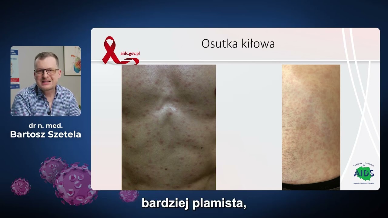 Najczęściej występujące zakażenia przenoszone drogą płciową.
