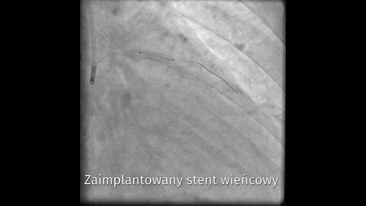 Angioplastyka: zaimplementowany stent