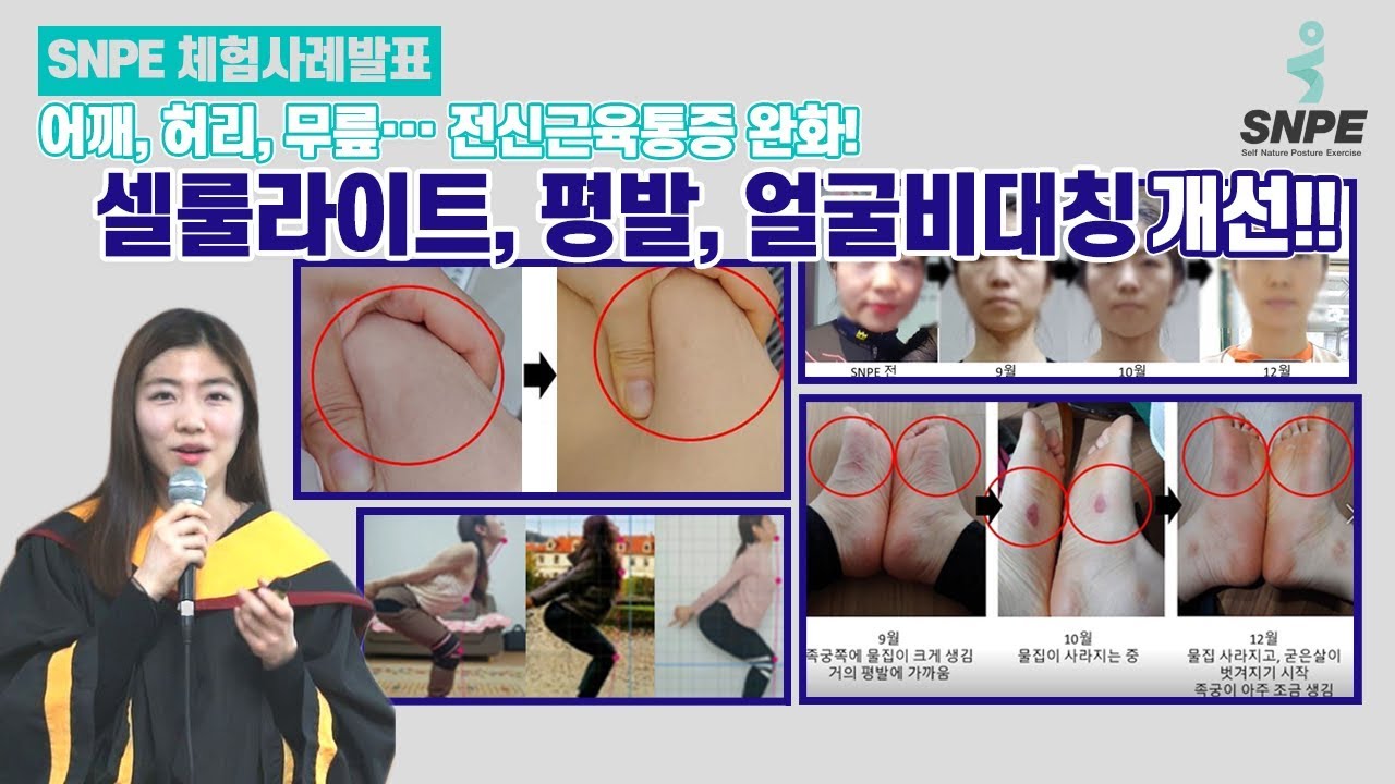 SNPE로 셀룰라이트, 평발, 얼굴비대칭 개선! 어깨, 허리, 무릎··· 전신근육통증 완화!  인생의 최고의 선물 'SNPE' - SNPE 체험사례발표