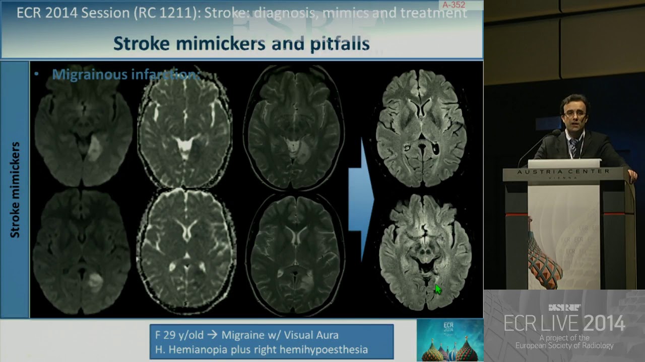 Neuro RC 1211   Stroke diagnosis, mimics and treatment 2