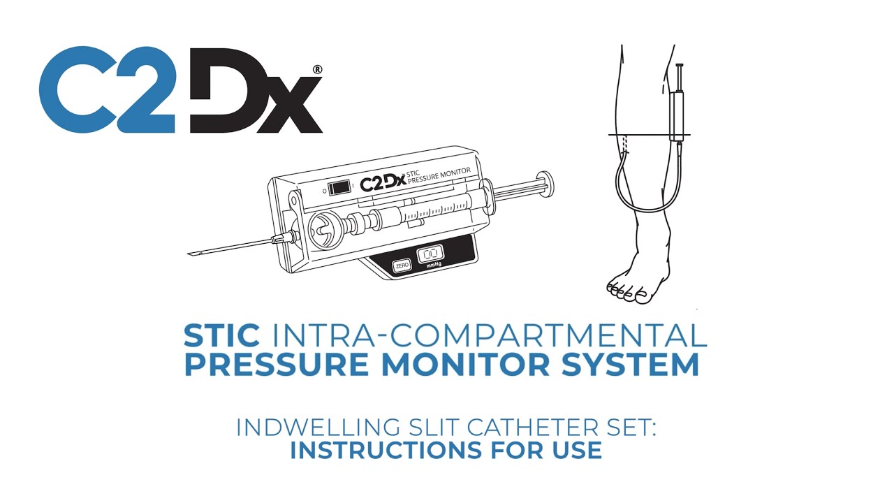 Measure Compartment Pressure - STIC (Indwelling Method) Instructions