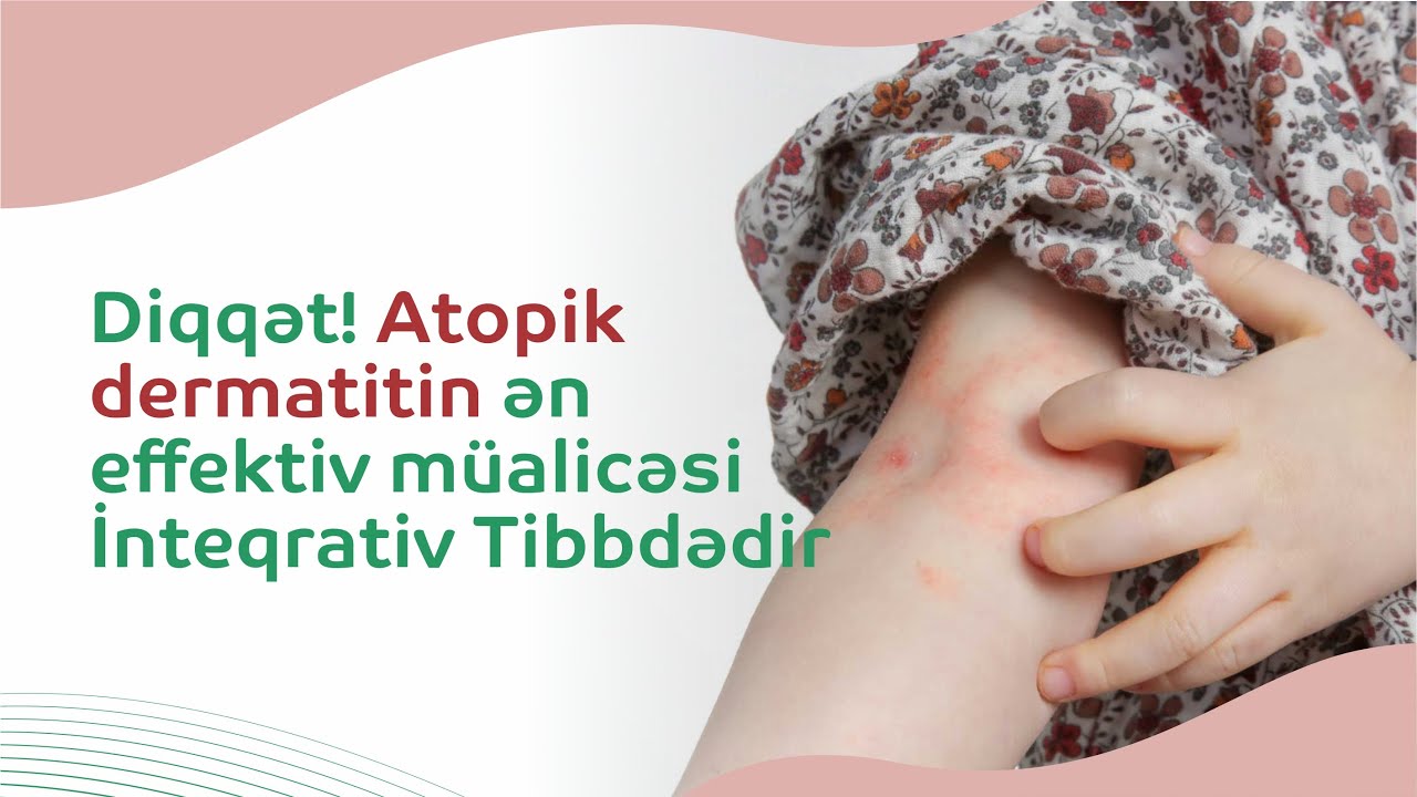 Diqqət! Atopik dermatitin ən effektiv müalicəsi İnteqrativ Tibbdədir #atopikdermatit