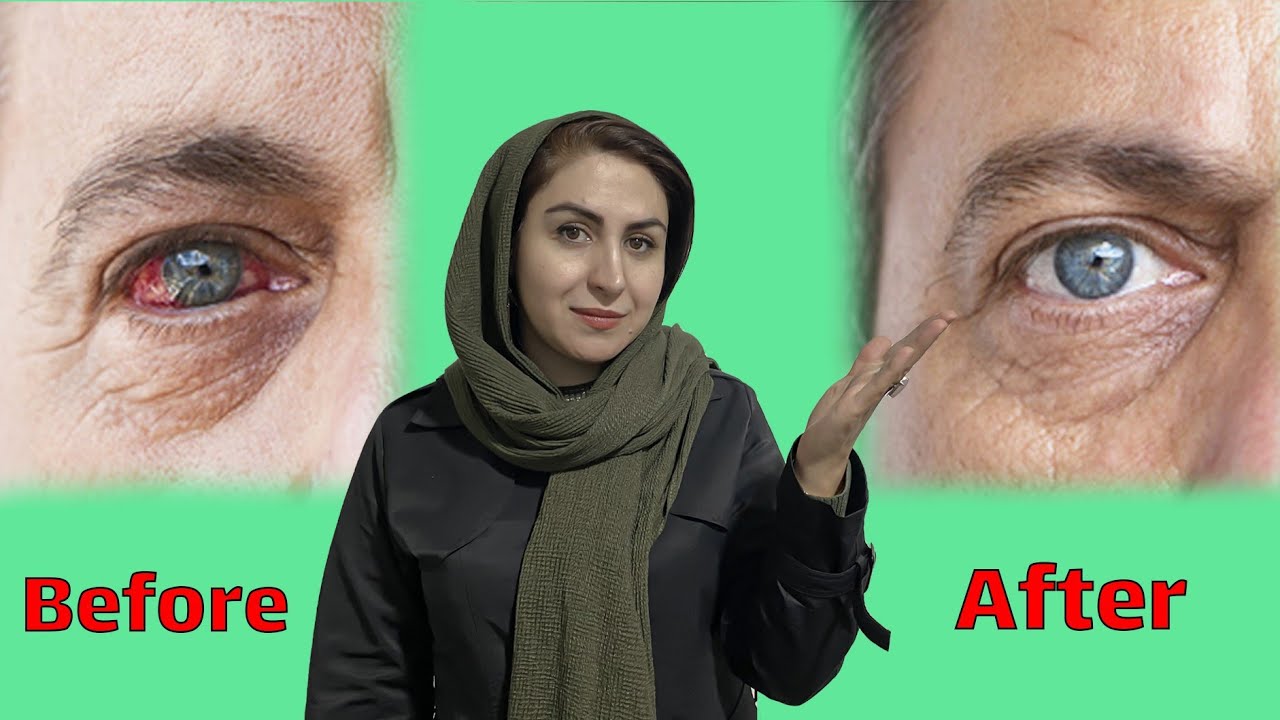 درمان نابینایی دیابتی | با این روش در کوتاهترین زمان ممکن مشکلات چشمی ناشی از دیابتت رو درمان کن!
