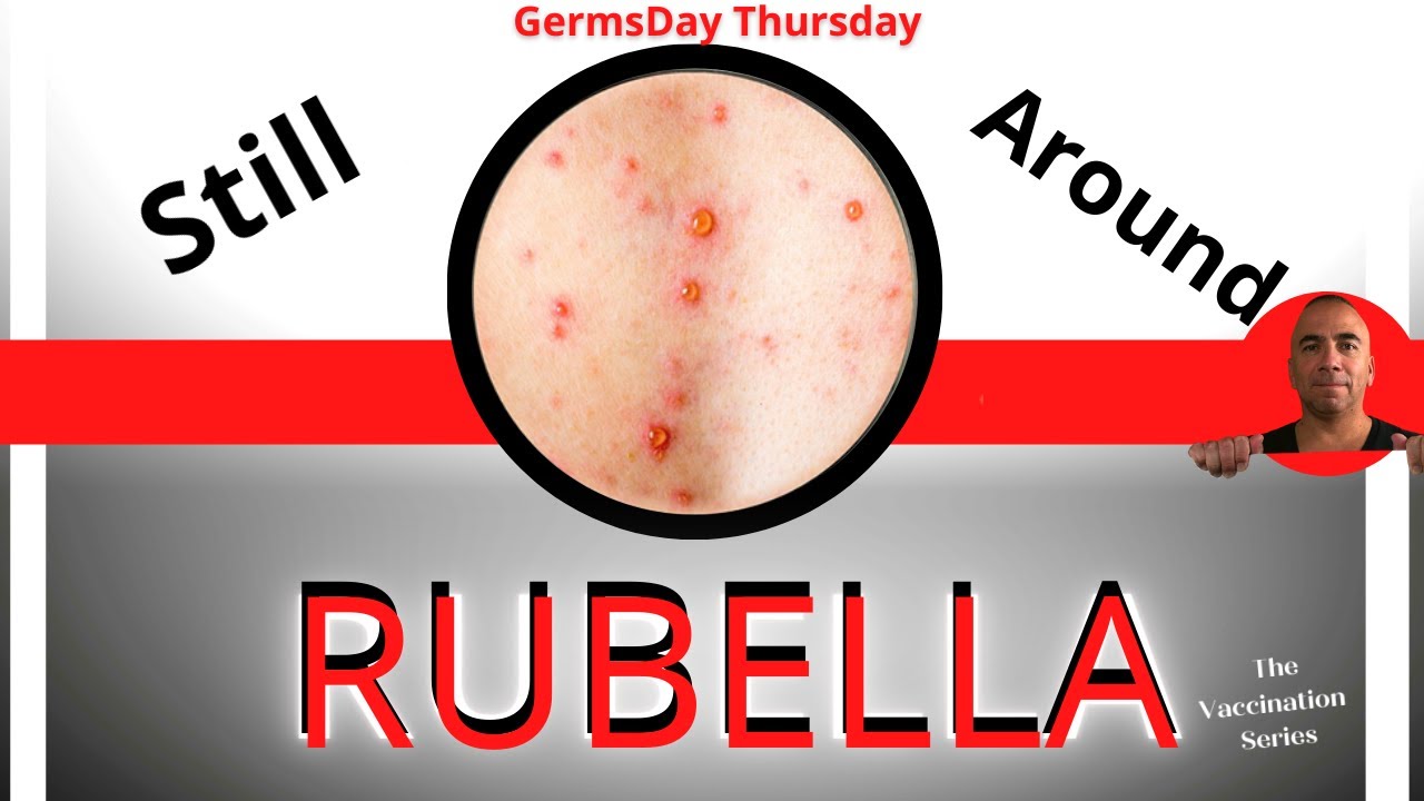 RUBELLA | German measles | 3 Day Measles ??? What are those??????