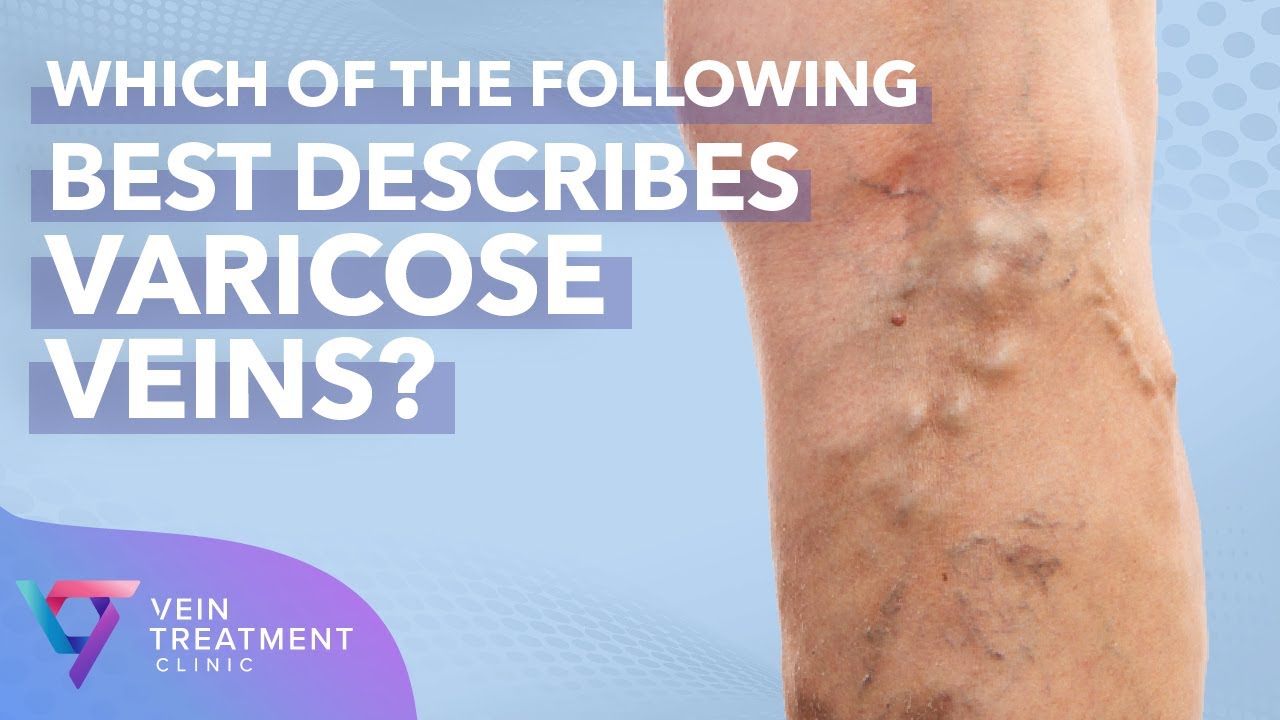 Medical Center: Which of the following best describes varicose veins | Vein Treatment Center