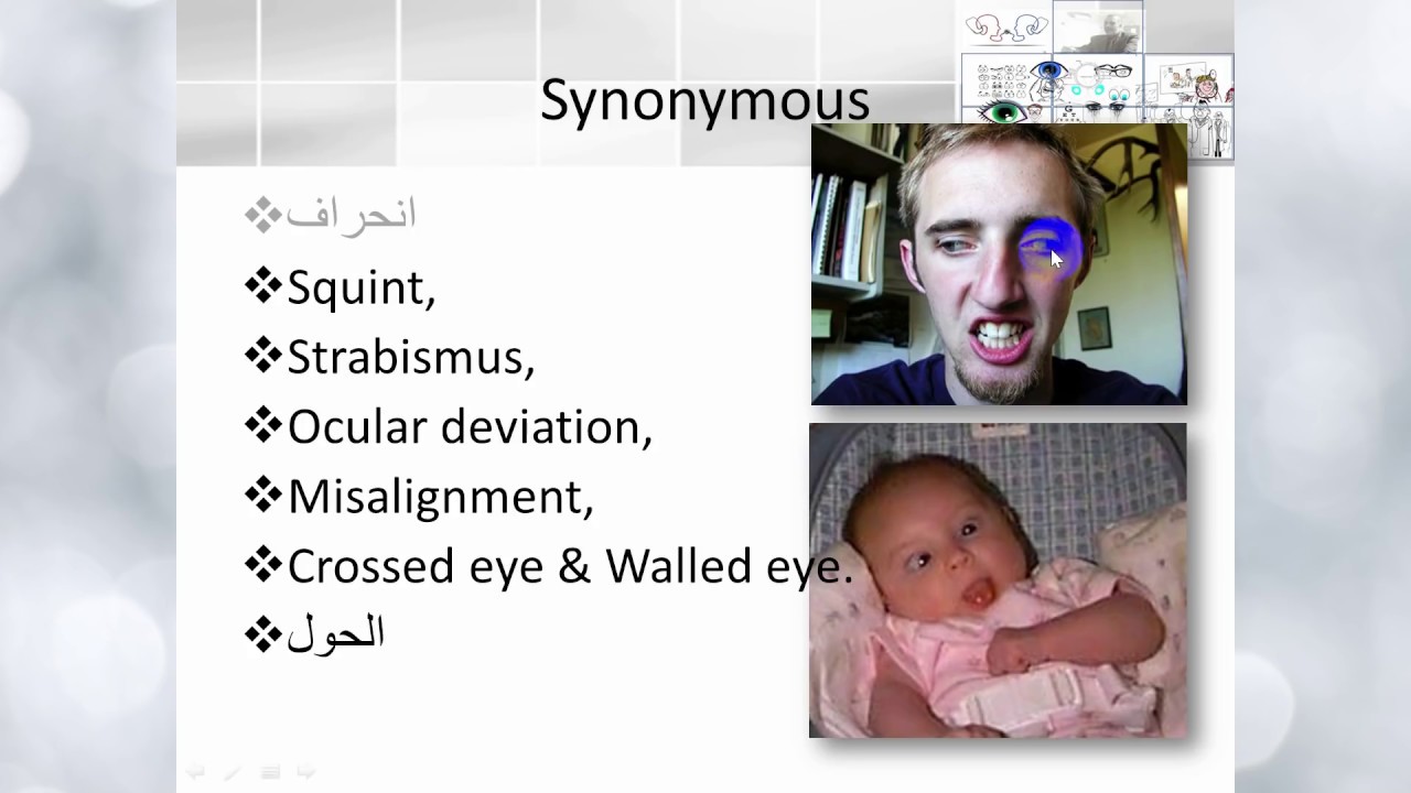 Squint; definition and types