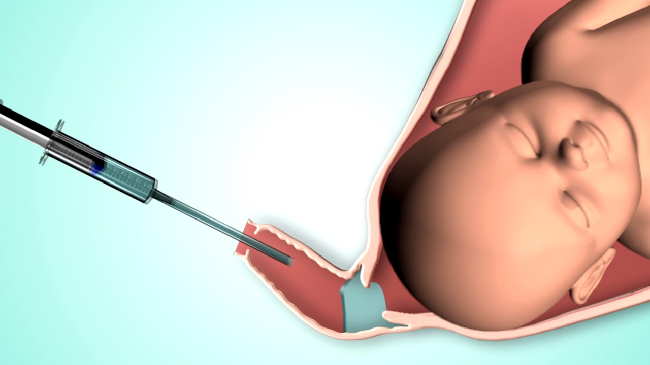Gynotal Obstetric Gel - Application