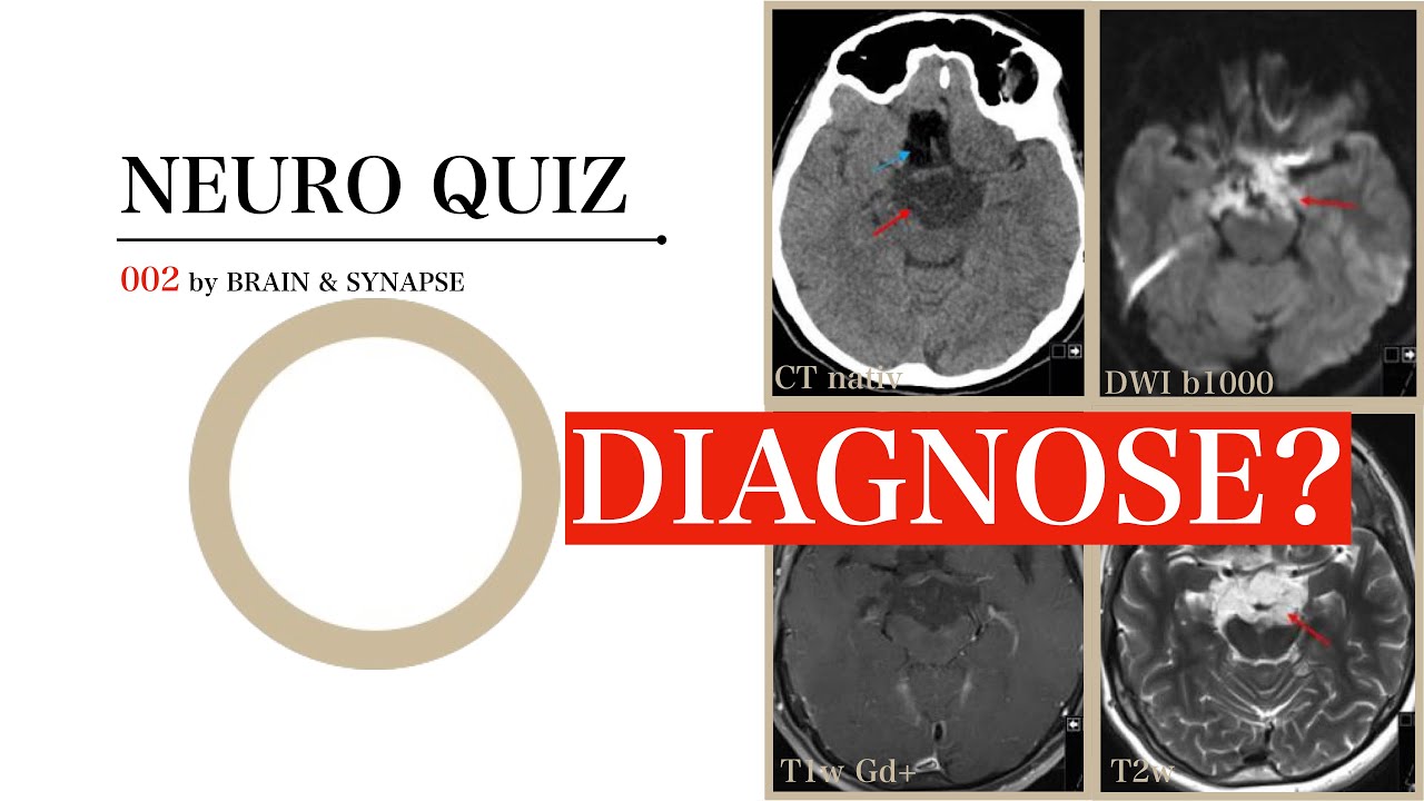 Neuro Quiz 002 I Diagnose? I Neuroradiologie I Gehirn I Brain & Synapse