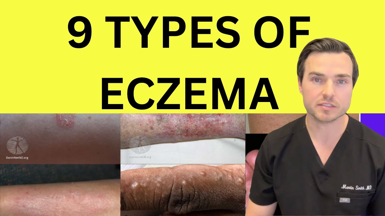 All 9 types of Eczema explained by Dr Martin Smith
