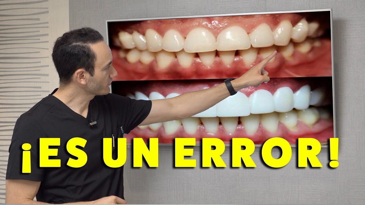 ¿Cortar encía y diseño de sonrisa el mismo día? 😱Mala idea 👎🏻