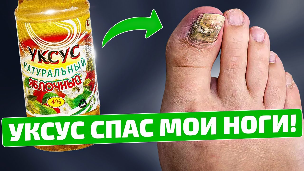 Избавилась от грибка быстро и просто с помощью уксуса!