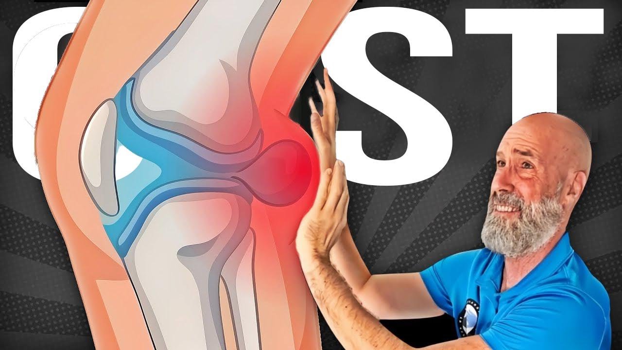 The Secret to Getting Rid of a Baker’s Cyst Without Surgery (3 Key Exercises)