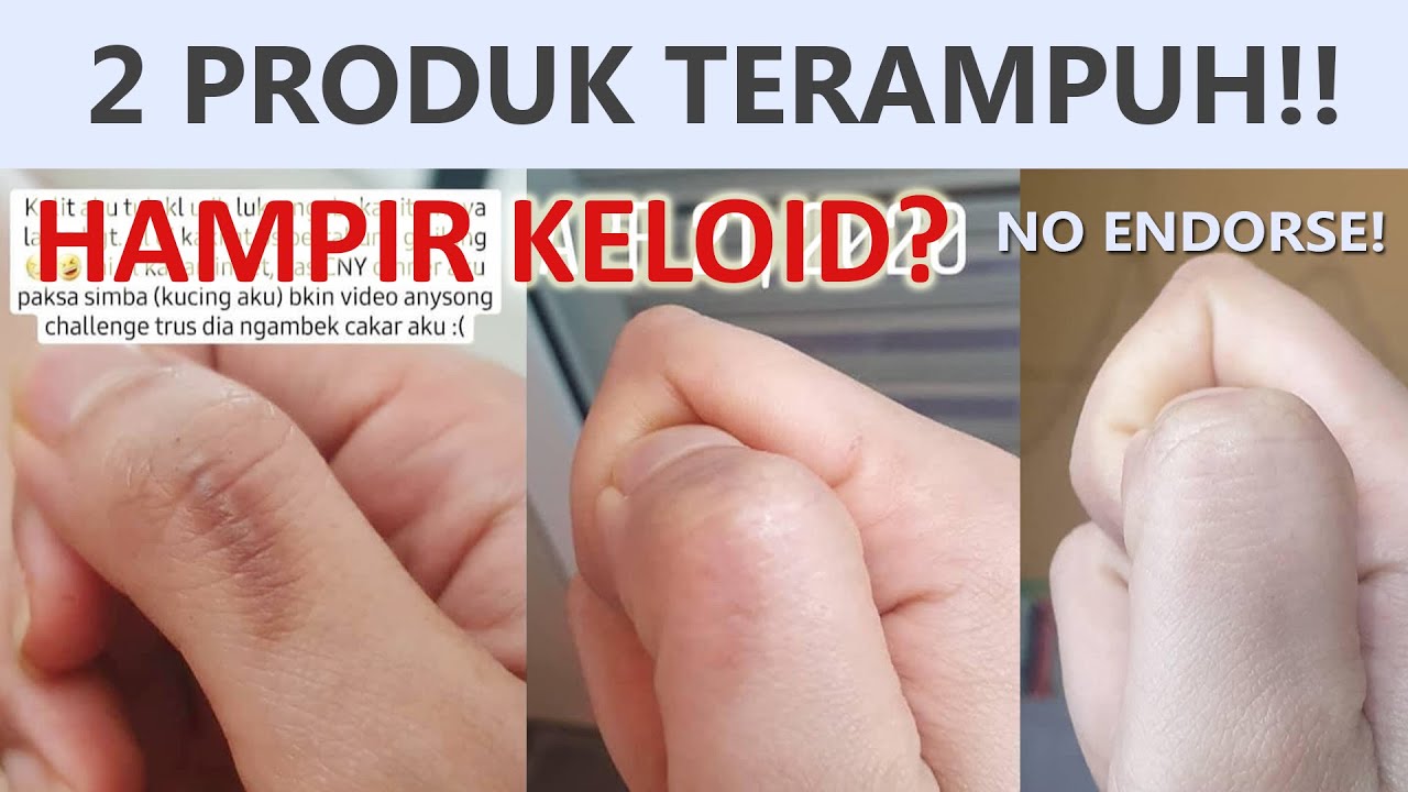 TERAMPUH ATASI BEKAS LUKA | SEBULAN HILANG!