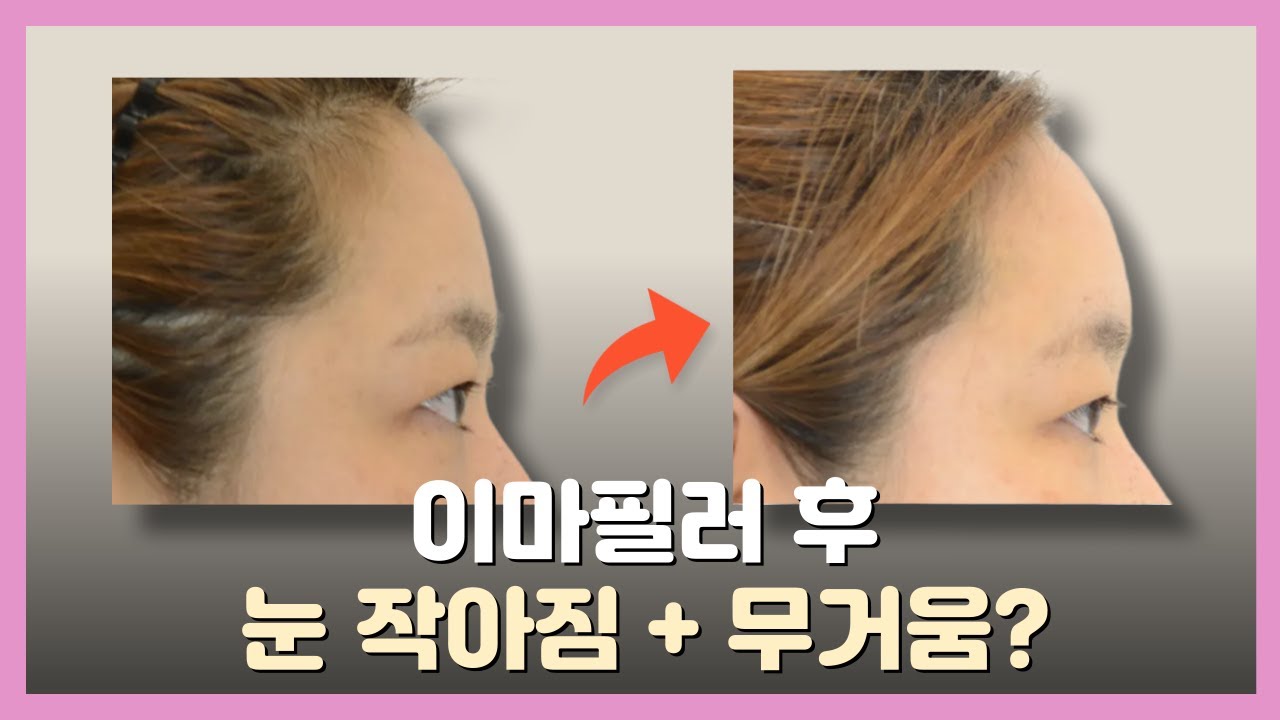 이마필러 부작용 걱정된다면 꼭 보세요! (눈 작아짐, 눈 무거워짐)