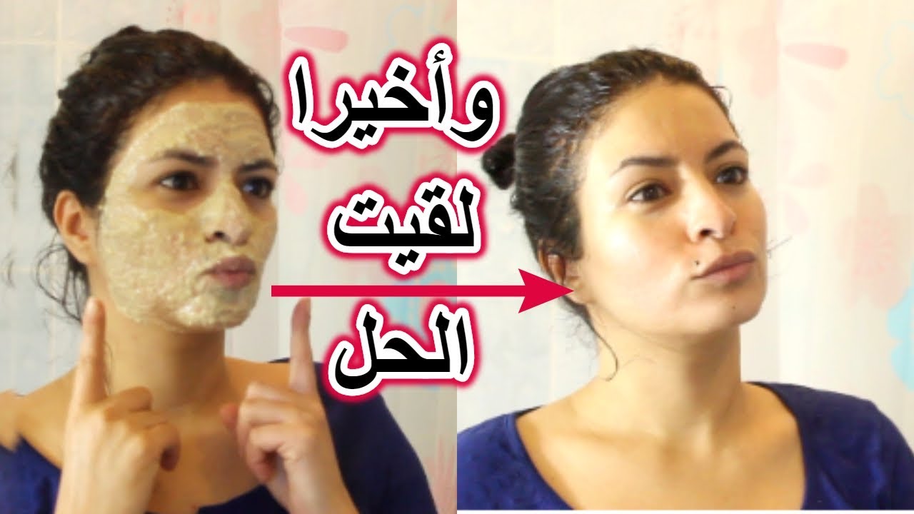 بشرتي تبهدلت وأصبحت حالتها حالة😣حطيت هاد الماسك يوم إيه يوم لا وشفت العجب /تغير جدري /الوصفة رهيبة❣