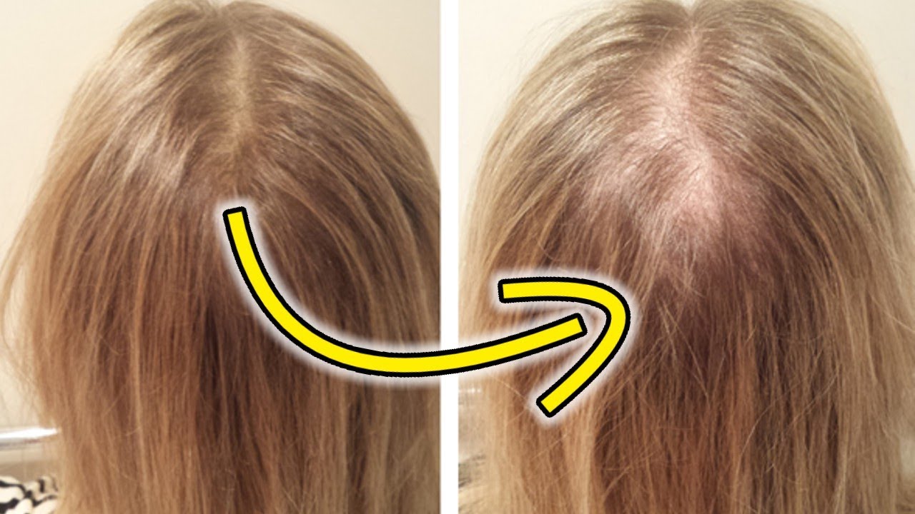 Eiwei&szlig;mangel: 10 Anzeichen, dass du zu wenig Proteine isst