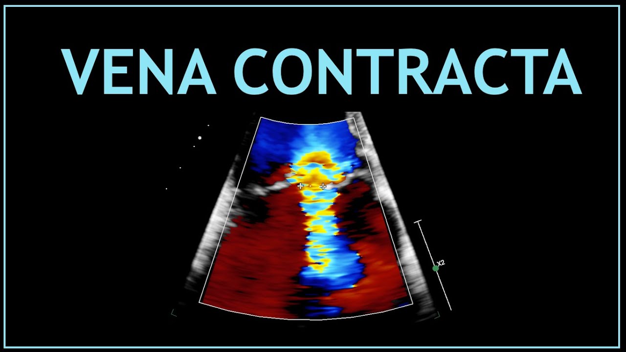 VENA CONTRACTA! (Ecocardiografia)