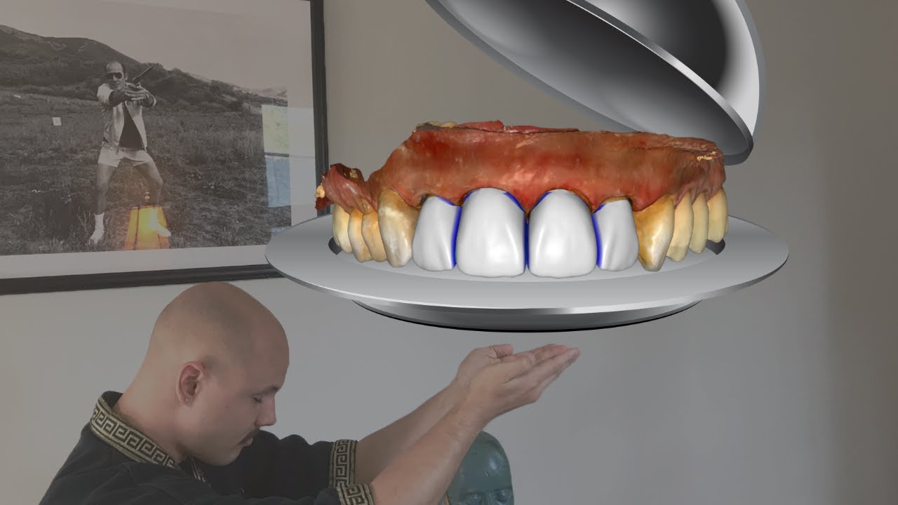 How to design 4 UNIT anterior case with CEREC/InLab