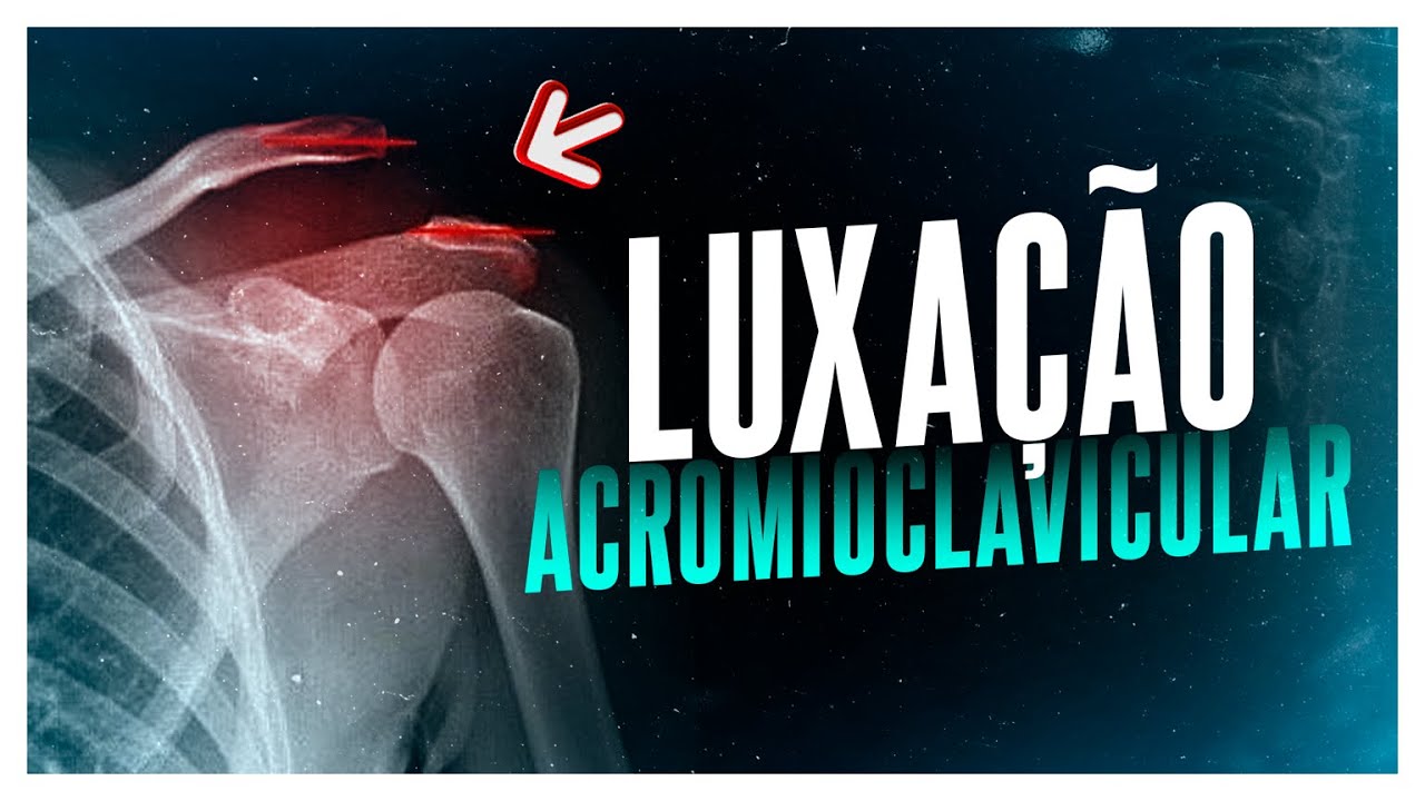 LUXAÇÃO ACROMIOCLAVICULAR