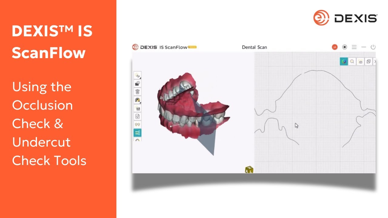 DEXIS&trade; IS ScanFlow - Using the Occlusion Check & Undercut Check Tools