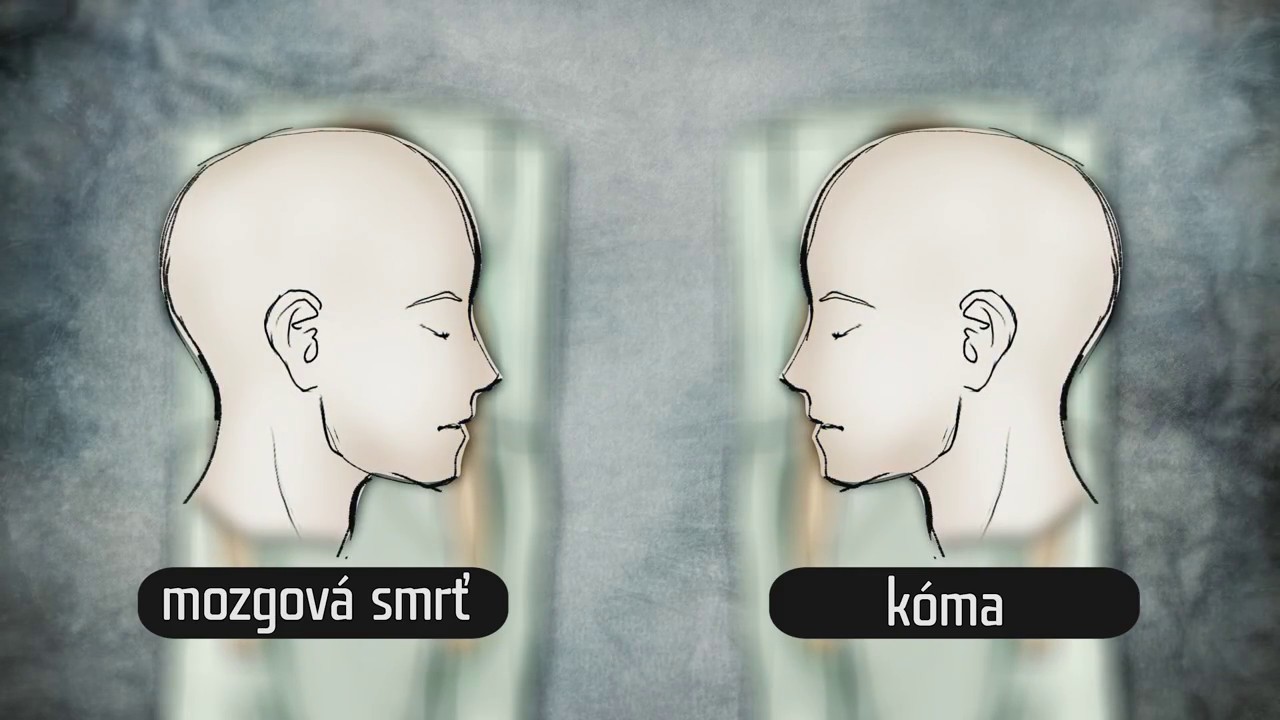 1/4 Mozgová smrť