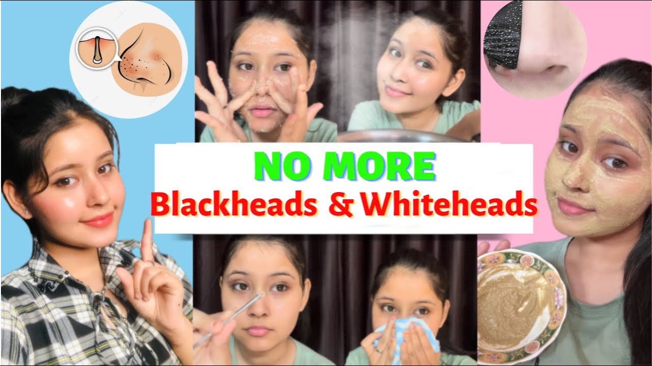 Skincare Challenge 💕:Get Rid of Blackheads, Whiteheads & Openpores in 1 Day | Deep Pore Cleaning😍