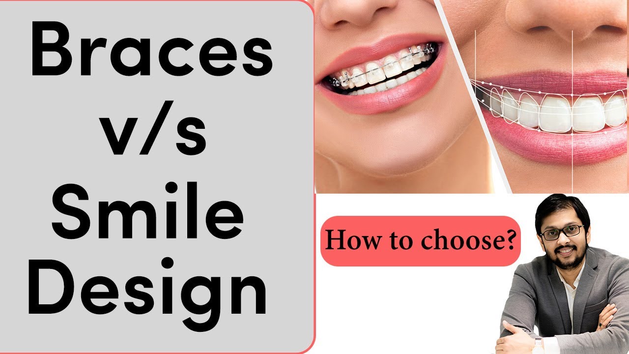 Braces vs Smile Design how to choose? | क्या चुने दोनों मे से? | Seraphic dental Indore