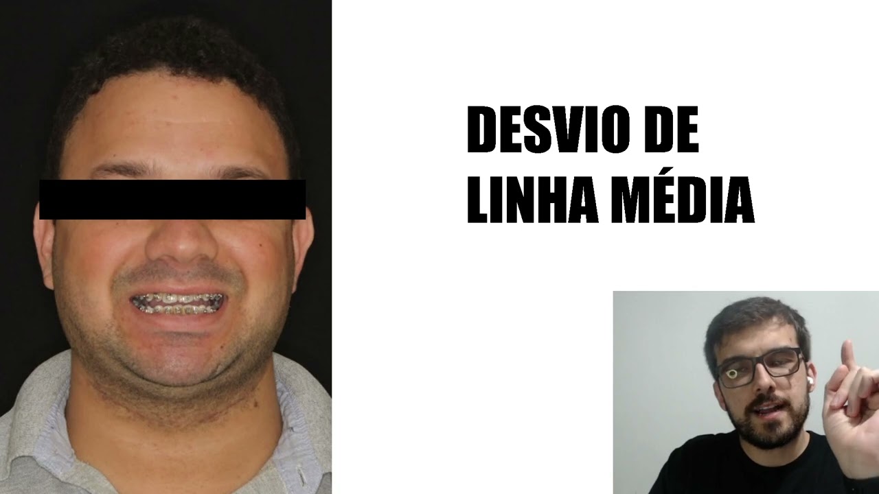 Desvio de Linha Média | Resumo de Ortodontia