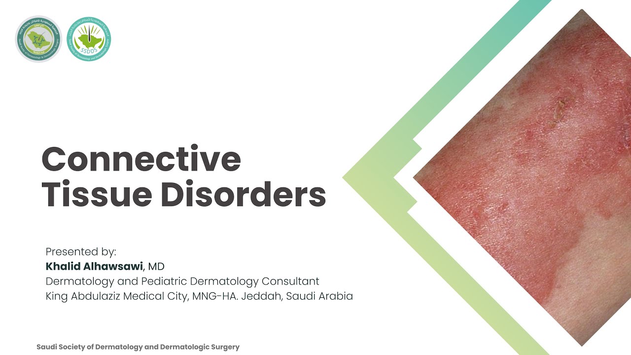 Lecture 19| Connective Tissue Disorders | Dr. Khalid Alhawsawi