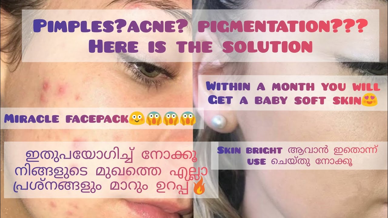Night skin care routine for all skin type|| Pimple, acne, pigmentation എല്ലാo ഒരാഴ്ചകൊണ്ട് മാറ്റാം🔥😍