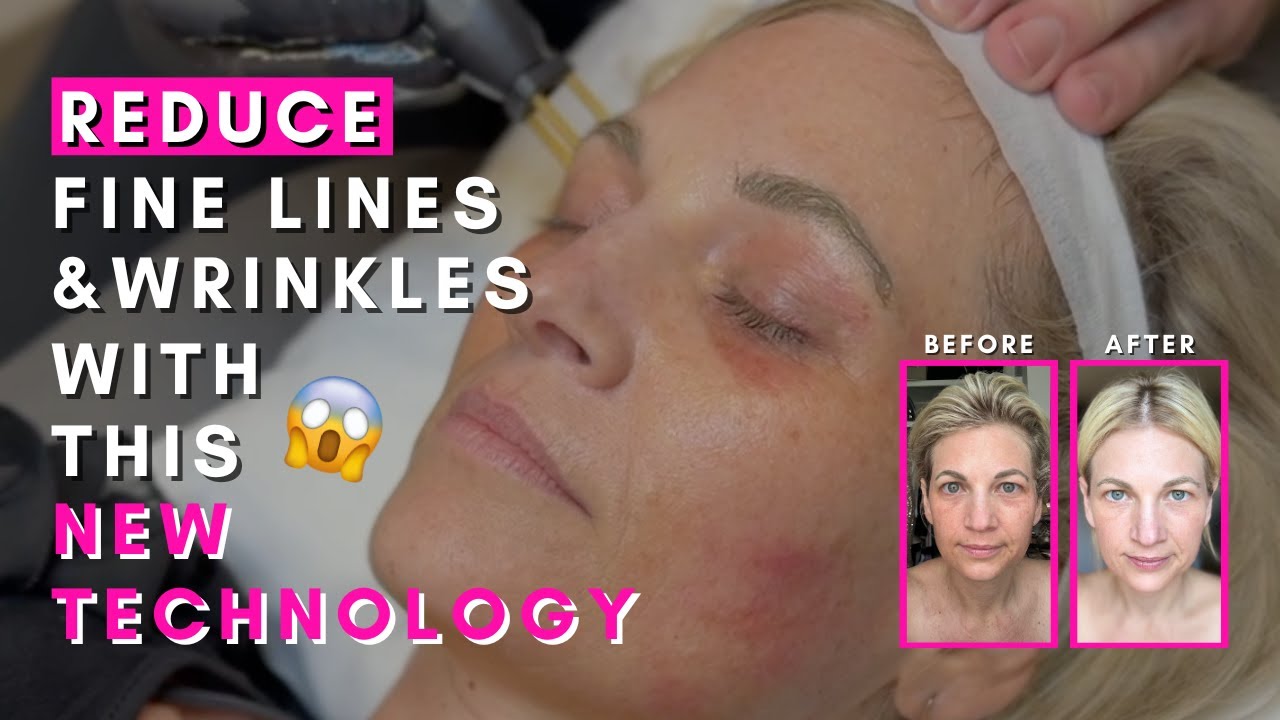 The #1 Skin Treatment for Flawless Results with Zero Downtime - NeoGen Interview