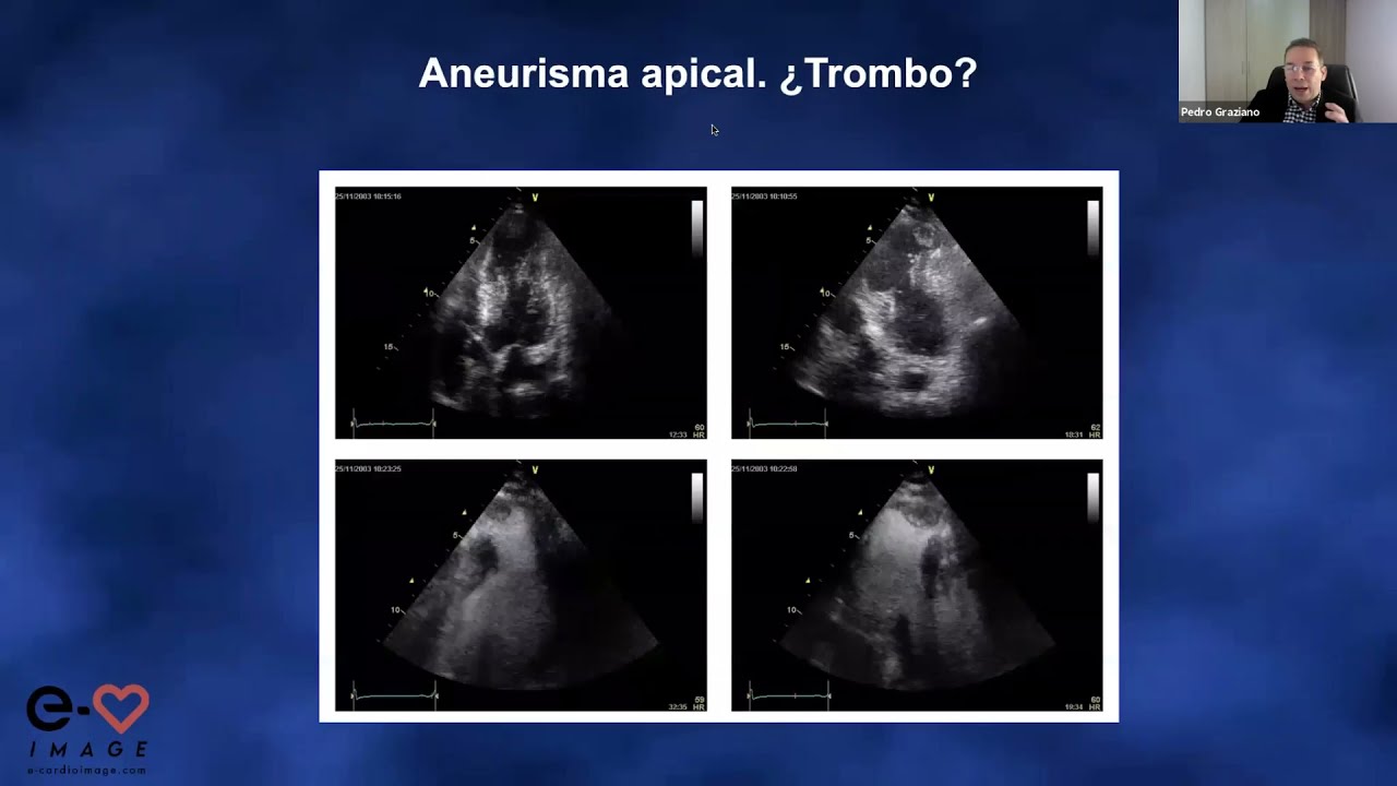 CUANTIFICACION DE FUNCION SISTOLICA DEL VENTRICULO IZQUIERDO (Dr. Graziano). 4º MODULO