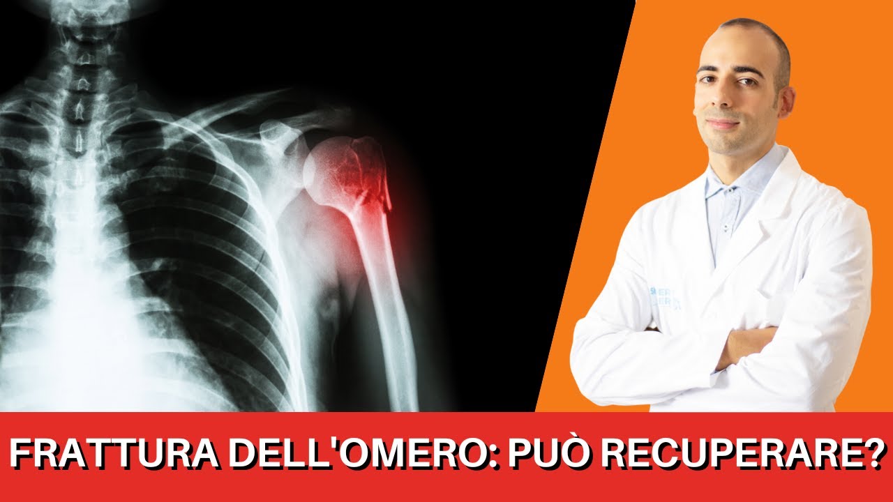 Una FRATTURA SCOMPOSTA dell'omero può guarire completamente?