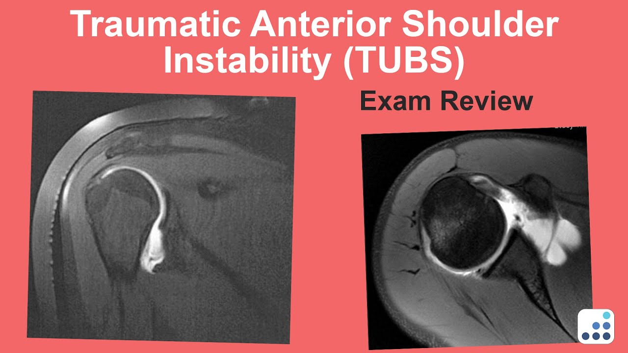 Traumatic Anterior Shoulder Instability (TUBS) Exam Review - Anthony Romeo, MD