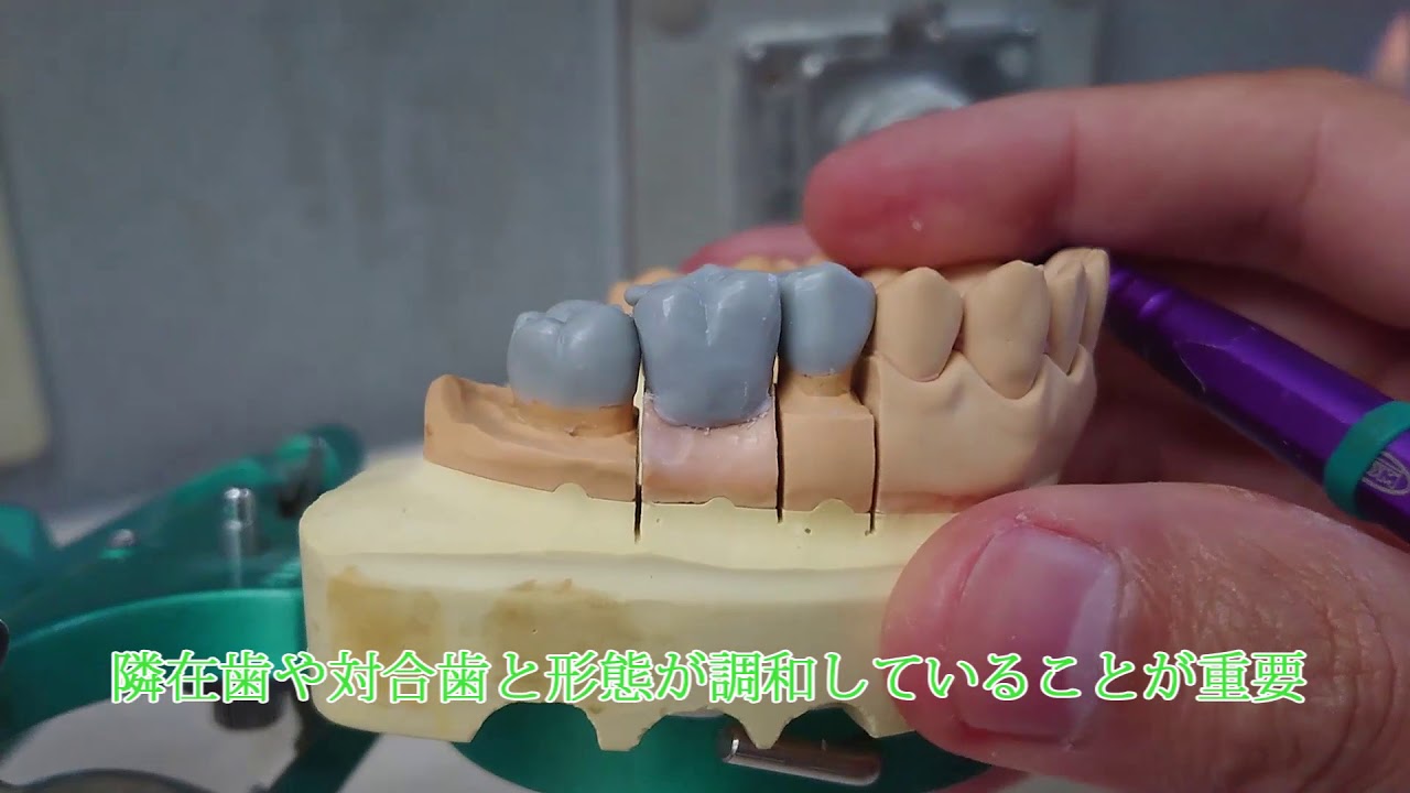 冠橋義歯補綴学２実習（第一大臼歯ポンティックろう型形成）