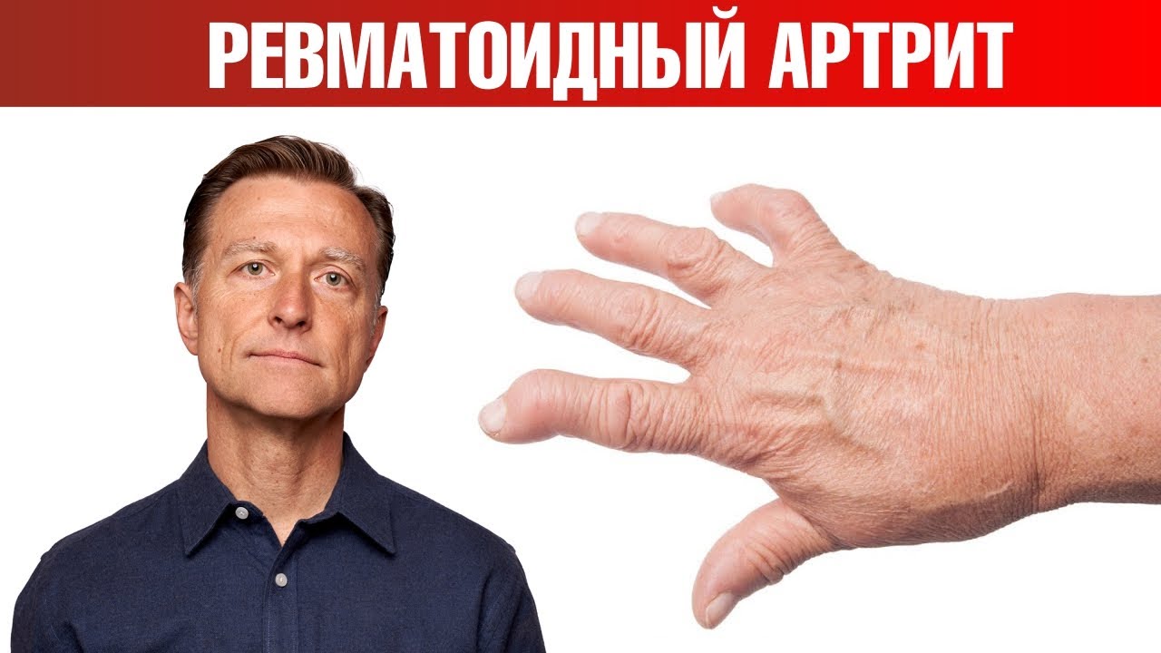 13 натуральных средств от ревматоидного артрита👌