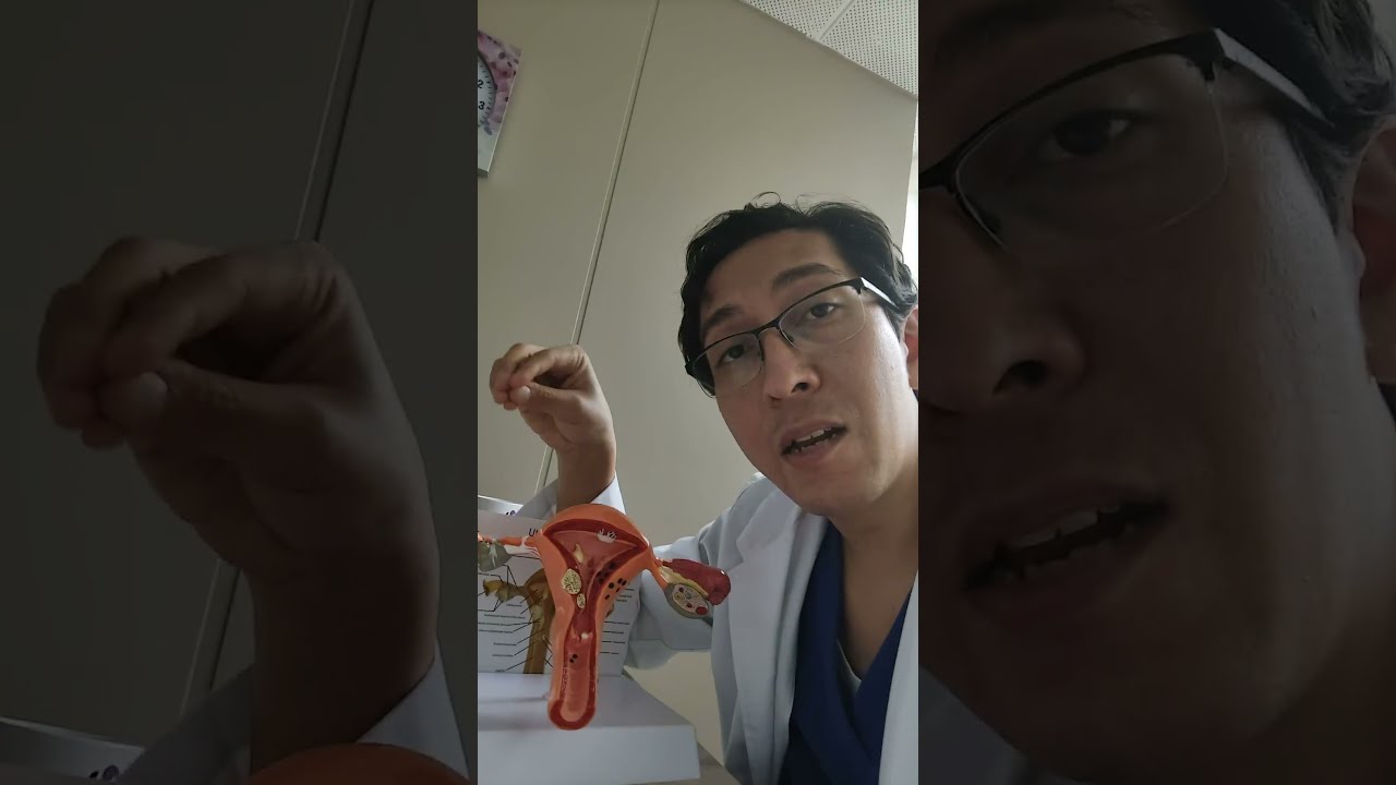 Como tratar los miomas uterinos. Miomectomía o histerectomía? Histeroscopia o Laparoscopia?