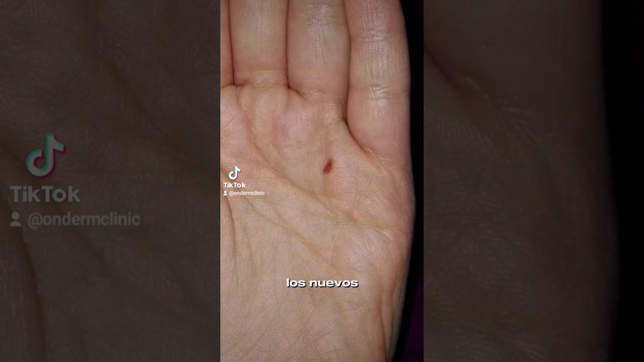 Lunares en las manos y pies &iquest;son malos? #lunares #dermatologo #cuidadodelapiel #onderm #melanoma