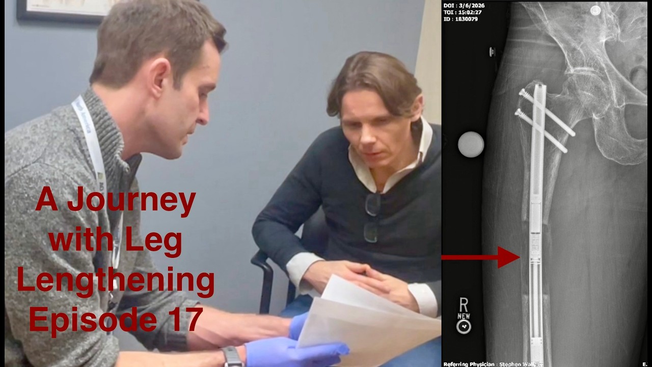 A Journey with Leg Lengthening - Episode 17 - 14 week follow up