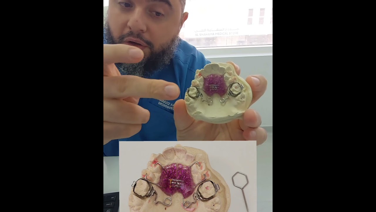 pendulum appliance #orthodontics #orthodontist #appliances