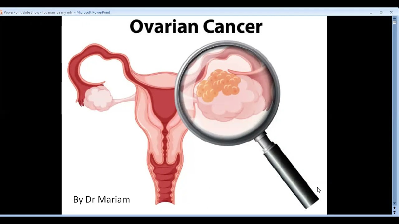 Ovarian Cancer | Part 1 | @Obsgynesimplified 