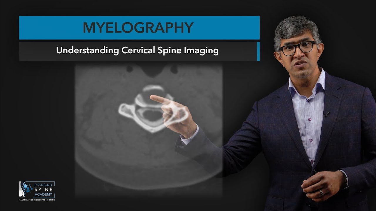 What is Myelography​ of the Cervical Spine?