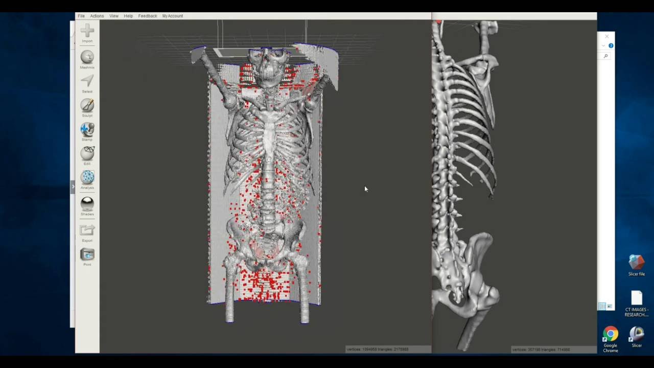 A ridiculously easy and free way to make 3D printable bones from CT scans
