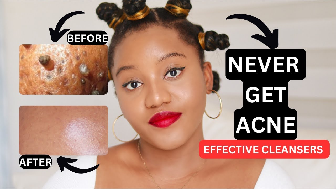 THE BEST ACNE PRODUCTS FOR BREAKOUT PRONE SKIN