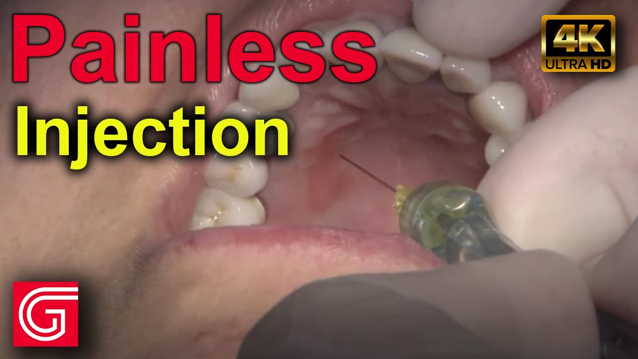 How to Give Painless Dental Injection by Michael DiTolla, DDS, FAGD
