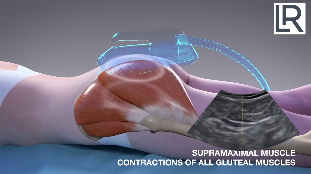 Build Muscle and Shed Fat with EmSculpt | Leif Rogers MD, FACS | Beverly Hills