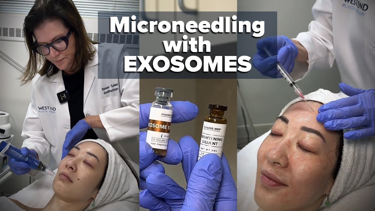 Why Exosome Microneedling is a Game-Changer for Skin Rejuvenation  | West End Plastic Surgery